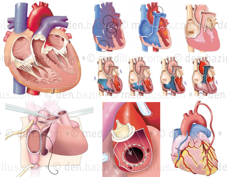 Cœur Medillus 